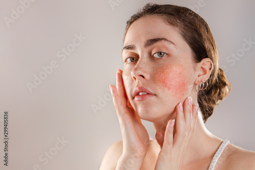 Medicine and cosmetology. Portrait of a young beautiful brunette woman with rosacea on her cheeks. Copy space