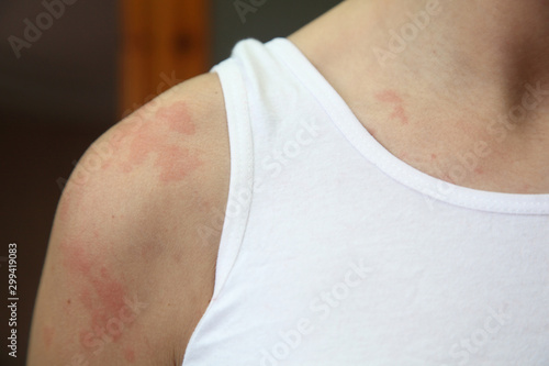 allergic dermatitis