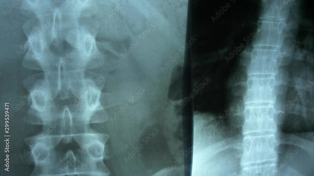 Clinician Examining X-Ray Image Of Patient's Spine and Chest POV