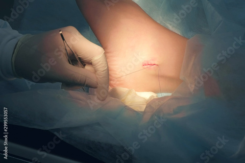 Surgeon man sutures ankle during surgery with neat stitches after removing hygroma  hands closeup. Doctor sewing on wound in operating room in hospital. Surgical treatment of hygroma.