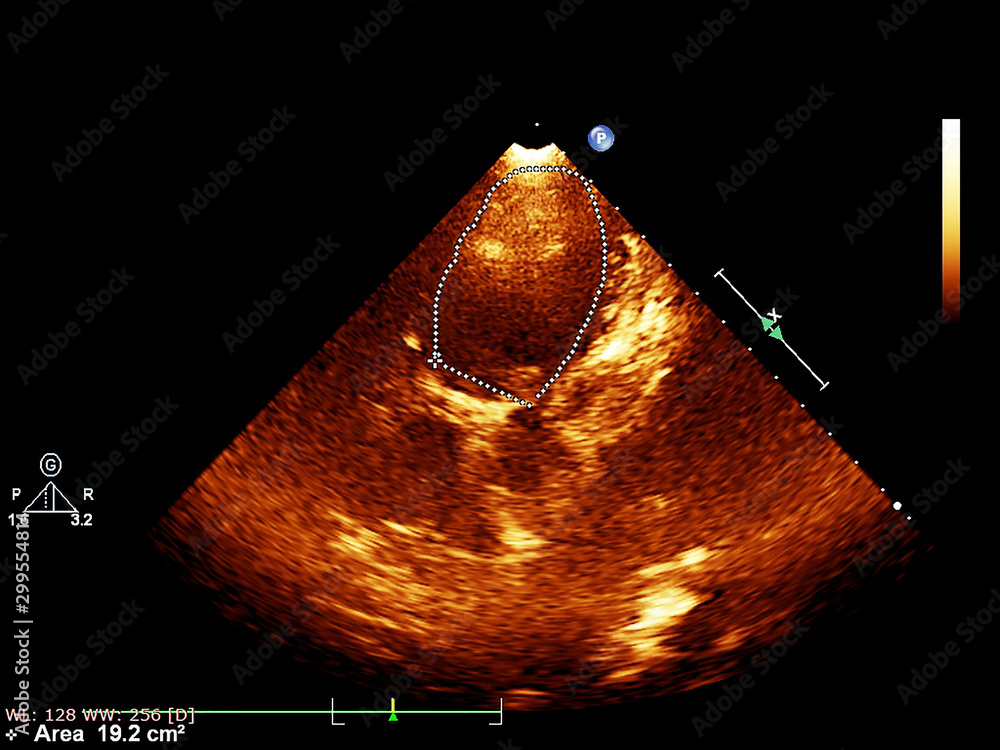 Screen of echocardiography (ultrasound) machine. Stock Photo | Adobe Stock