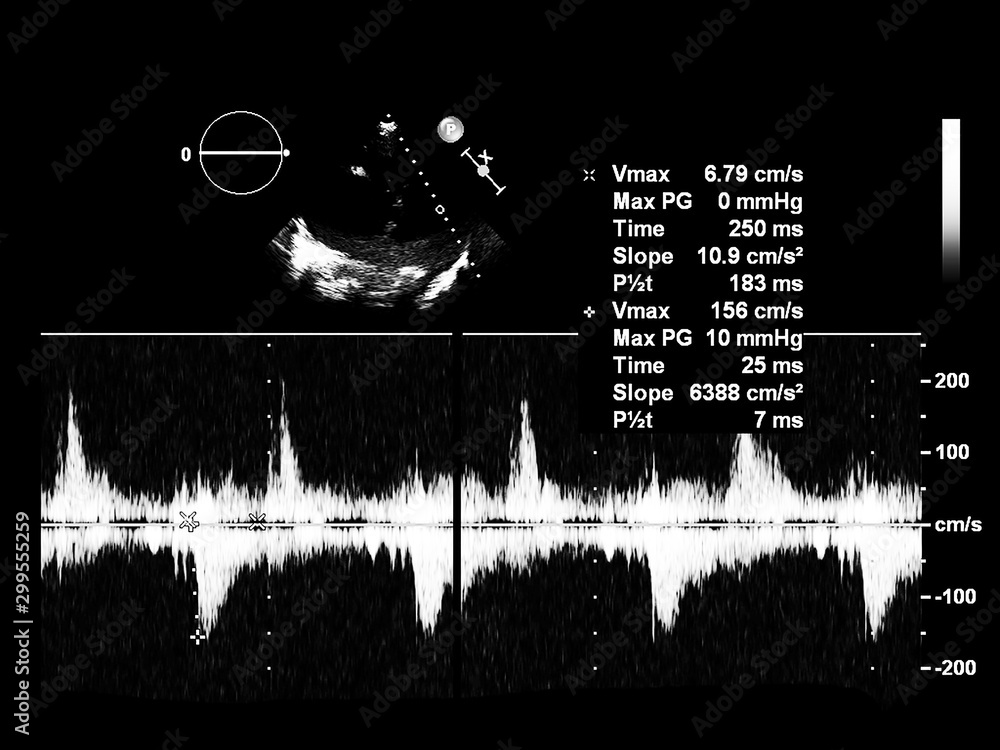 Screen of echocardiography (ultrasound) machine. Stock Photo | Adobe Stock