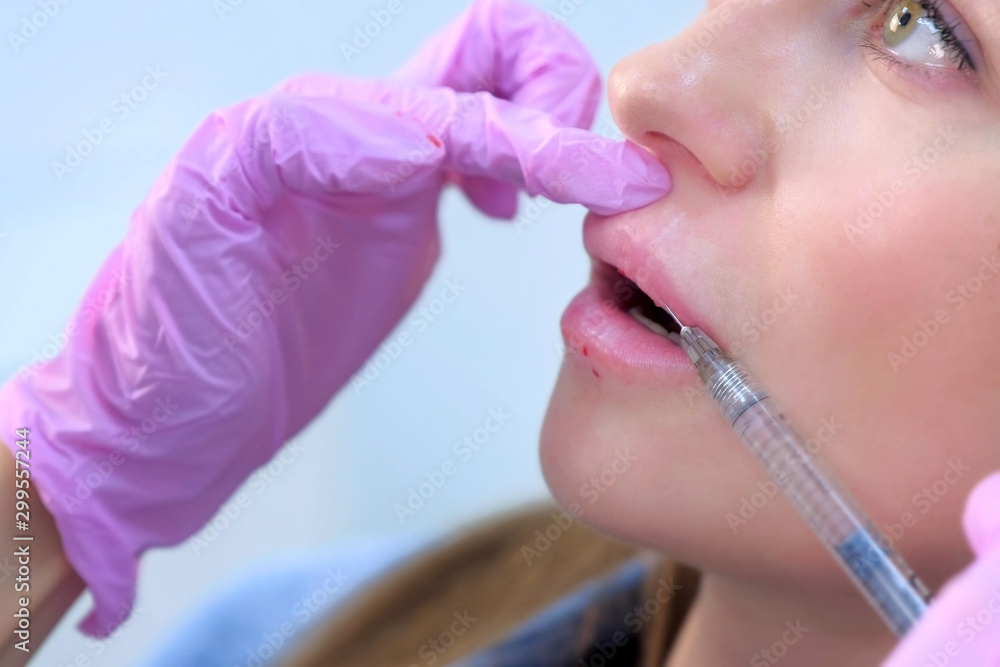 Injection in patient woman lips to volume and correction shape making by doctor cosmetologist. Beautician injects filler collagen or hyaluronic acid into lips with syringe. Contour Plastic of Lips. Injection in patient woman lips to volume and correction shape making by doctor cosmetologist. Beautician injects filler collagen or hyaluronic acid into lips with syringe. Contour Plastic of Lips.