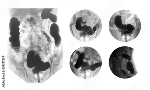 Foto Lower gastrointestinal (GI) tract radiography (lower GI or barium enema), an x-r