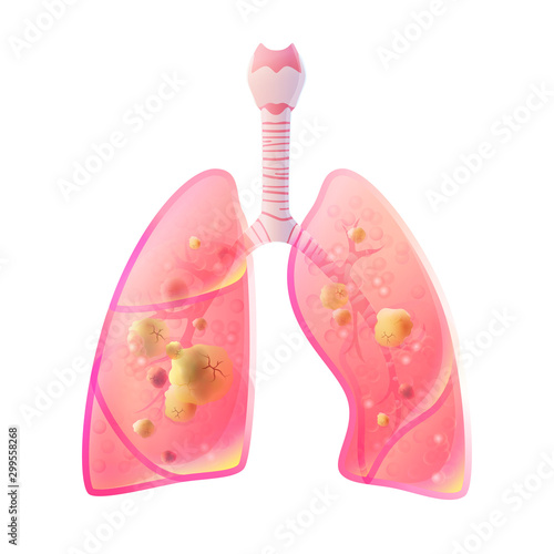Vector illustration of lung cancer