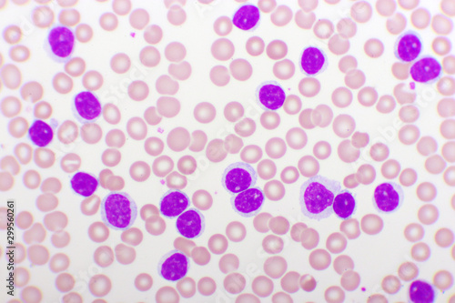 Blood picture of chronic lymphocytic leukemia or CLL, analyze by microscope, original magnification 1000x