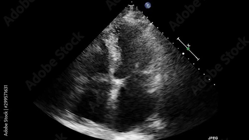 Transesophageal Ultrasound Echocardiography.