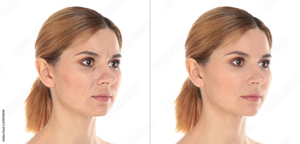Woman before and after plastic surgery on white background Woman before and after plastic surgery on white background