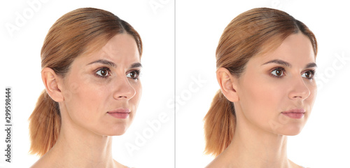 Woman before and after plastic surgery on white background