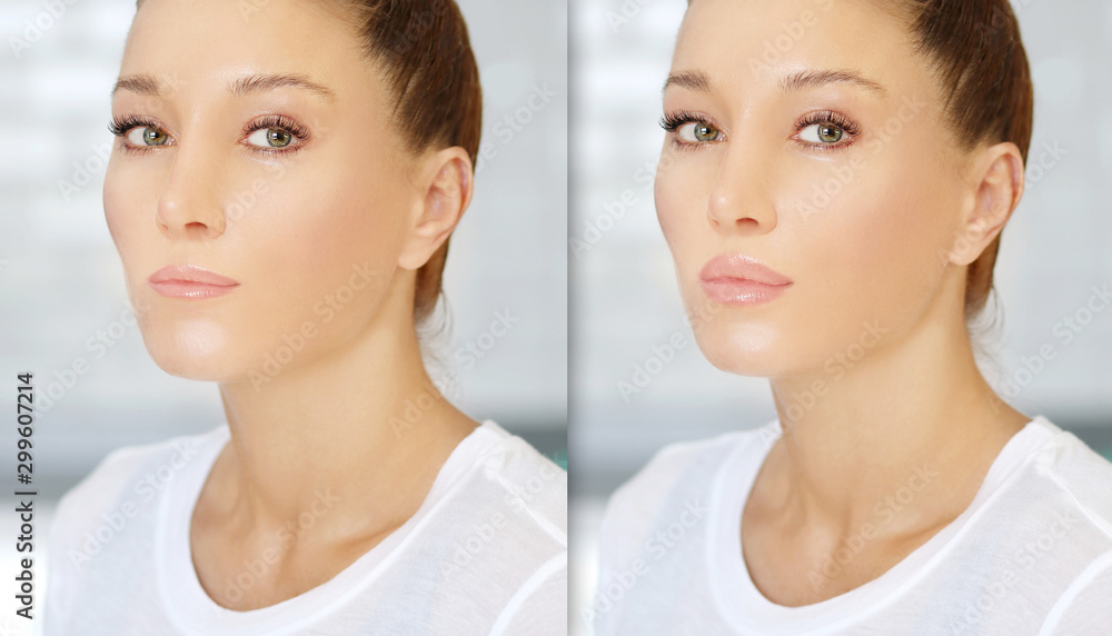 Beauty injections.Concept of rejuvenation.Lip augmentation