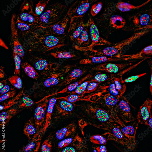 Fluorescent Imaging immunofluorescence of cancer cells growing in 2D with nuclei in blue, cytoplasm in red and DNA damage foci in green