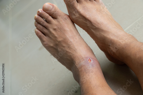Foot ulcers caused by disease. photo