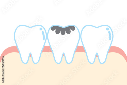 虫歯のかわいい歯のイラスト cute cartoon decayed tooth illustration