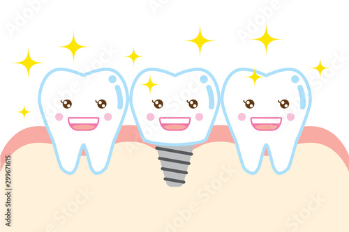 インプラントのかわいい歯のイラスト cute cartoon illustration implant tooth