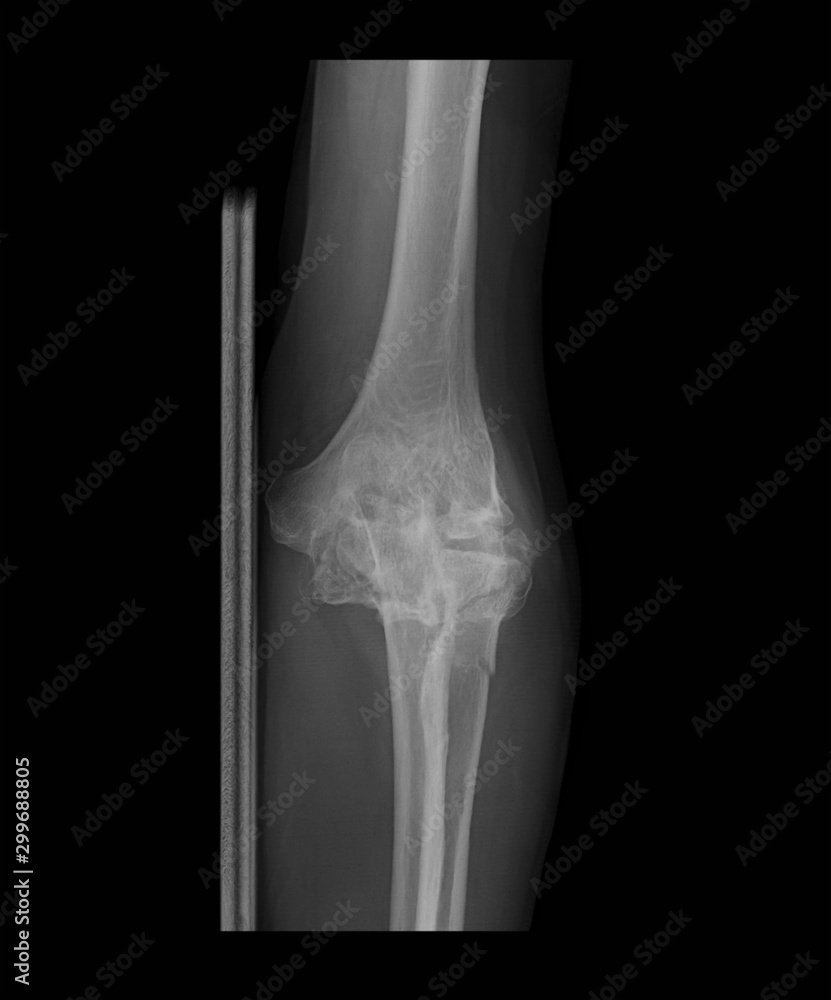 Xray image of left elbow with wooden splint, anteroposterior (AP) view