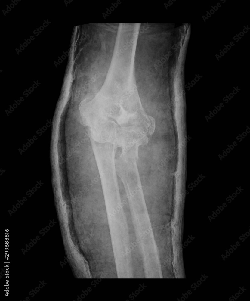 Xray image of left elbow fracture with plaster cast, anteroposterior
