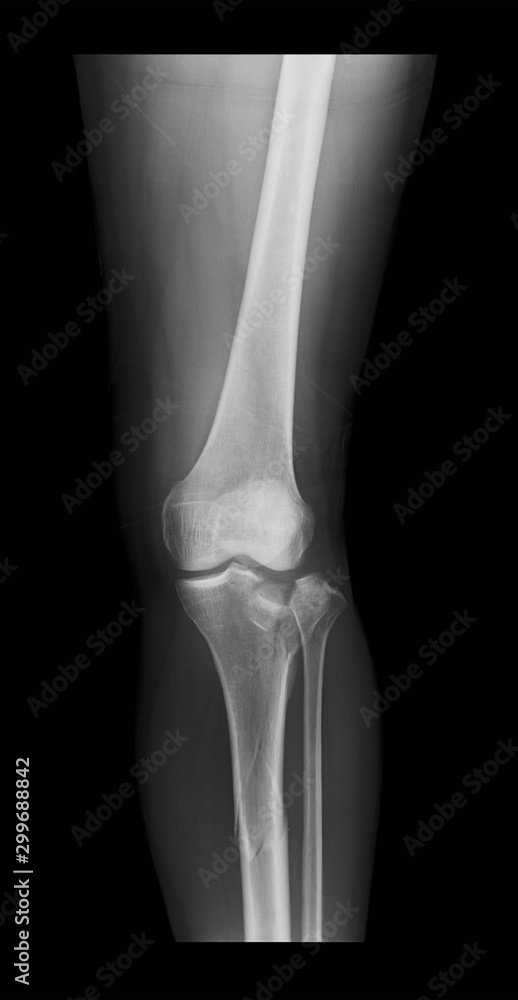Right knee Xray image shows tibia and fibula fractures, lateral view
