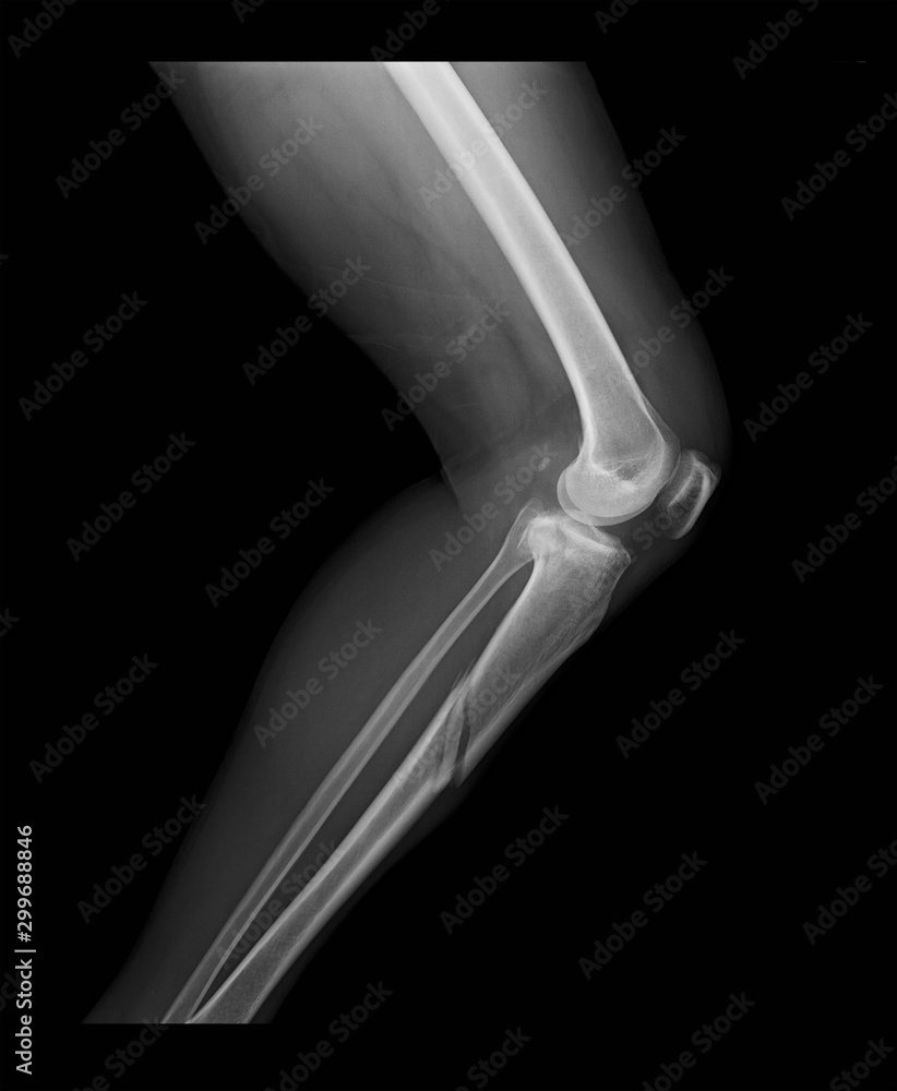 Right knee X-ray image shows tibia and fibula fractures, lateral view ...