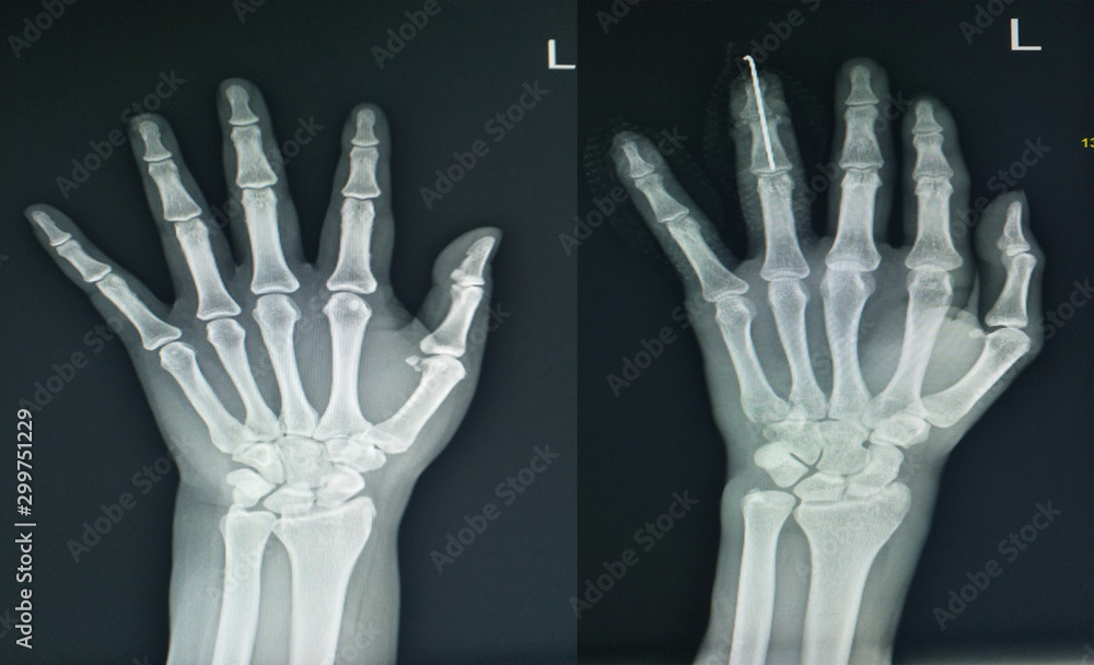 x-ray left hand two views finding normal and fracture finger. x-ray left hand two views finding normal and fracture finger.
