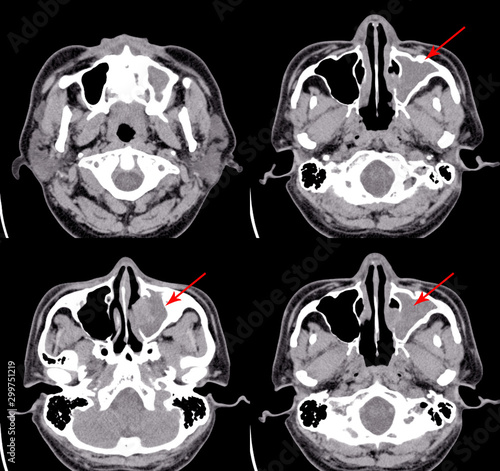 CT Brain and paranasal sinuses Impression: Chronic sinusitis of Lt maxillary sinus. photo