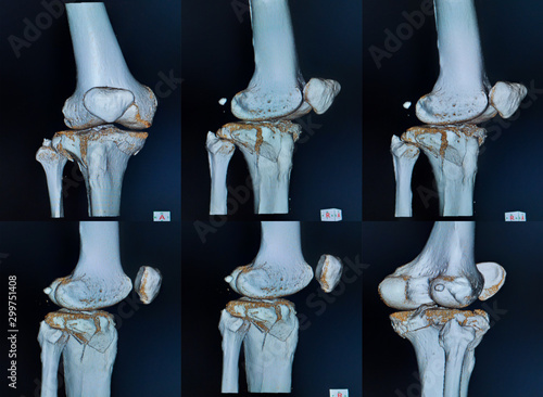 CT scan and 3D computer rendering image of a knee of the patient suffering from comminuted fracture of tibial plateau and proximal tibia. photo