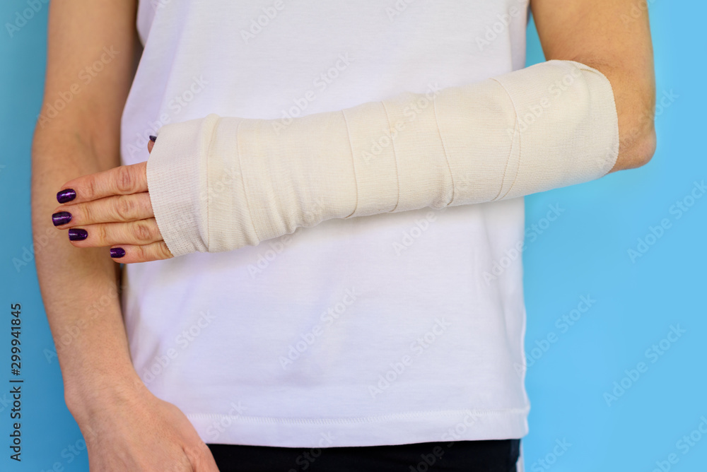Woman with broken arm bone in cast, plastered hand on blue background. Close up.