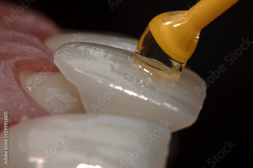 Foto veneer fixation macro photography