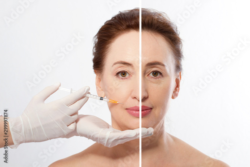 Closeup woman middle age face before after collagen face injection. Wrinkle anti aging concept. Beauty cosmetic procedures. nasolabial folds facelift. Elderly female face macro. Skin care before-after