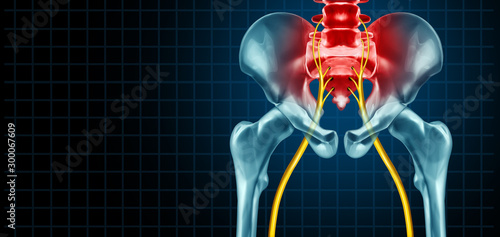 Painful Sciatic Nerve photo