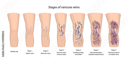 Stages of varicose veins: spider, reticular, nodes, swelling, discoloration skin, eczema, trophic ulcer. Image of healthy and diseased legs. Vector illustration in flat style with main description.