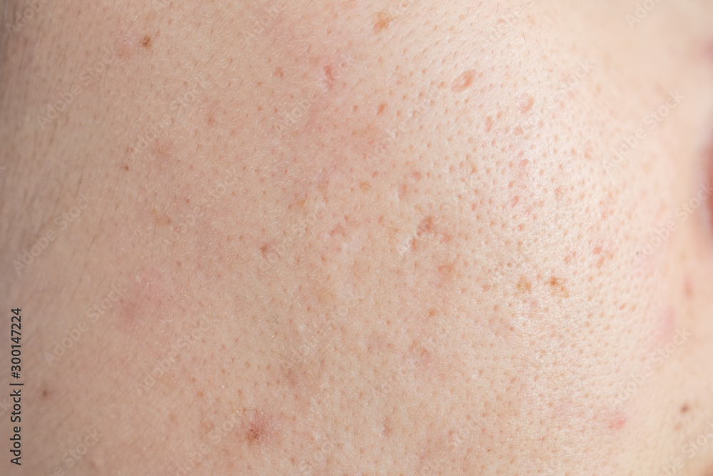 Close up of woman face has problems with skin on her face. Problems with acne and scar on the female skin.