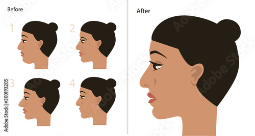 Plastic Surgery Face and Head before after. vector illustration.