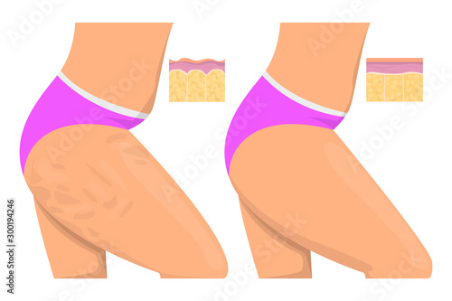 Cellulite on the hips vector isolated. Before and after, female