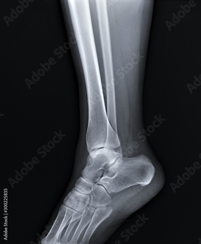 normal radiograph of the ankle joint