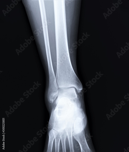 normal radiograph of the ankle joint