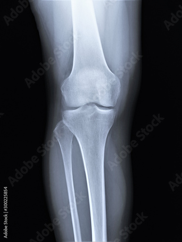 normal radiography of the knee joint in direct projection, medical diagnostics, Traumatology and orthopedics, rheumatology