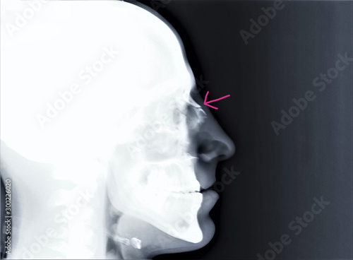 x-ray with a fracture of the back of the nose, traumatology and orthopedics, traumatology, sports injury photo