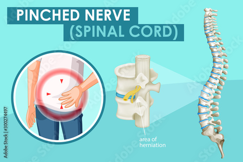 Diagram showing pinched nerve in human