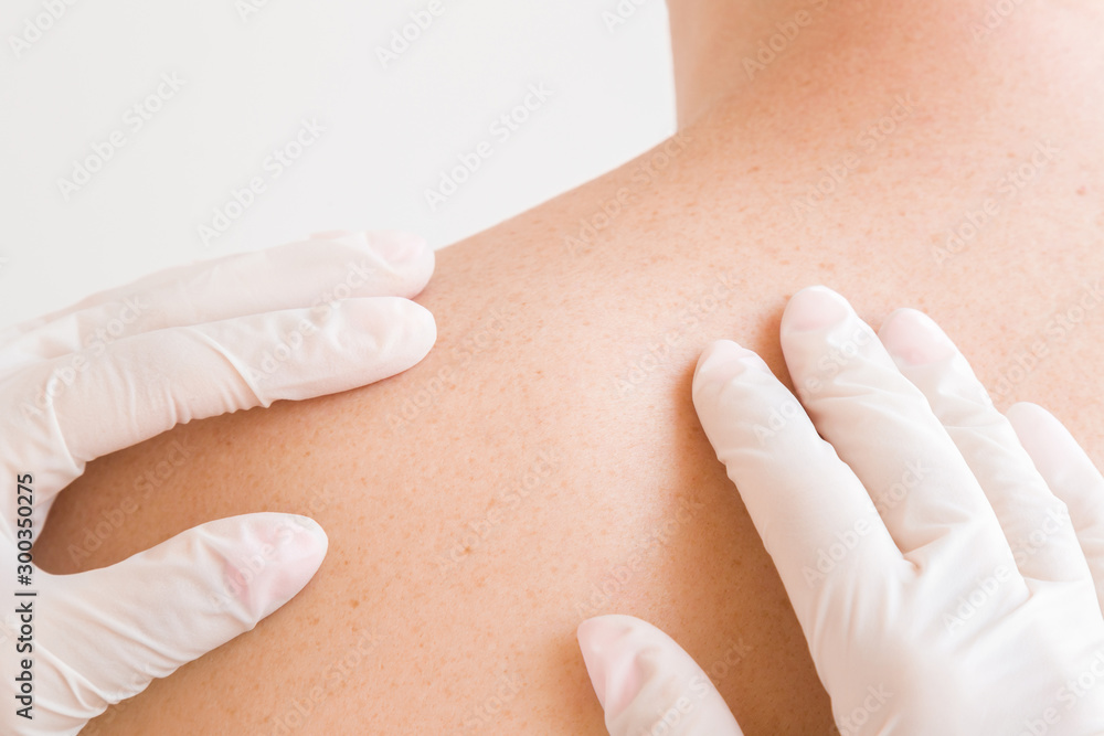 Fototapeta premium Doctor hands in rubber protection gloves checking skin of young man. Brown freckles on shoulder. Back view. Closeup.