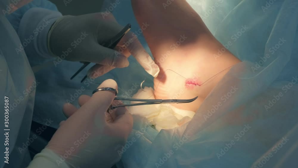 Surgeon man sutures ankle during surgery with neat stitches after removing hygroma, hands closeup. Doctor sewing on wound in operating room in hospital. Seams with self-absorbable threads.