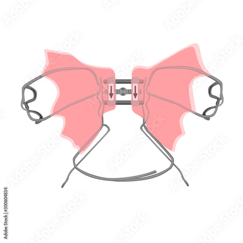 Palatal expander for the maxilla, vector illustration. The removable orthodontic appliance to make the upper jaw wider. This appliance is commonly used to treat children and adults with narrow jaws