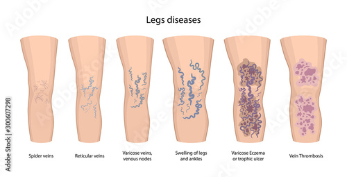 Legs diseases: spider, reticular, nodes, swelling, discoloration skin, eczema, trophic ulcer, thrombophlebitis and thrombosis. Vector illustration in flat style isolated on white background
