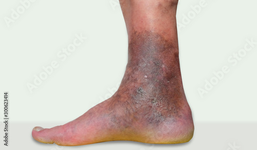 Tableau sur toile varicose veins leg ulcers
