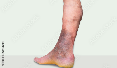 Tableau sur toile varicose veins leg ulcers3