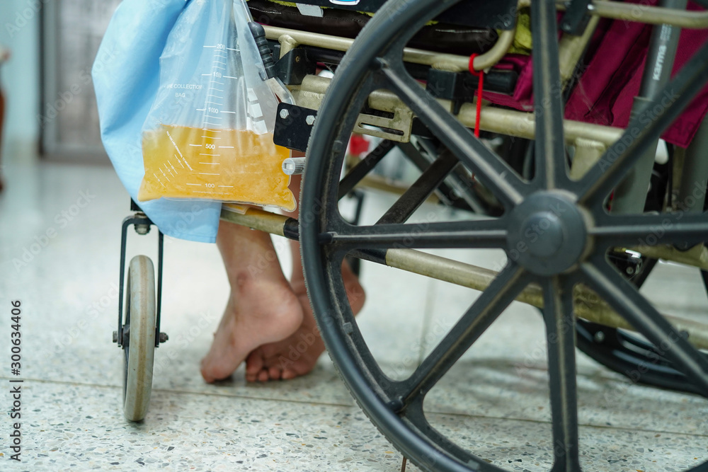 Asian middle-aged lady woman patient sitting on wheelchair with urine bag in the hospital ward : healthy medical concept .