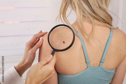 Bild auf Leinwand Doctor dermatologist examines birthmark of patient