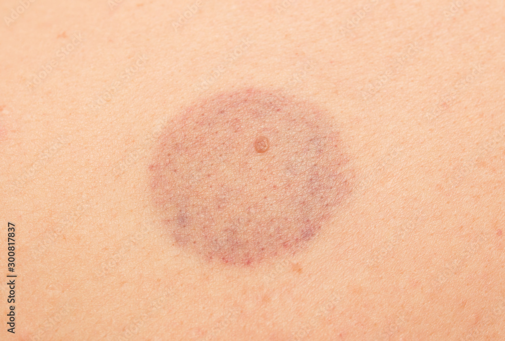Fototapeta premium Bruise on the skin