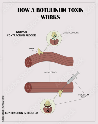 Drug medication medicine made botulin botulinic botulinum toxin produced bacteria used cosmetology remove wrinkles infographics information poster students and patients beautician cosmetologist doctor