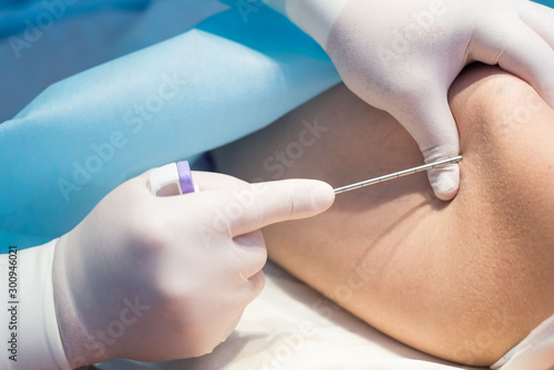 Foto An oncologist, using a long needle, pierces a childs ilium to diagnose bone marr