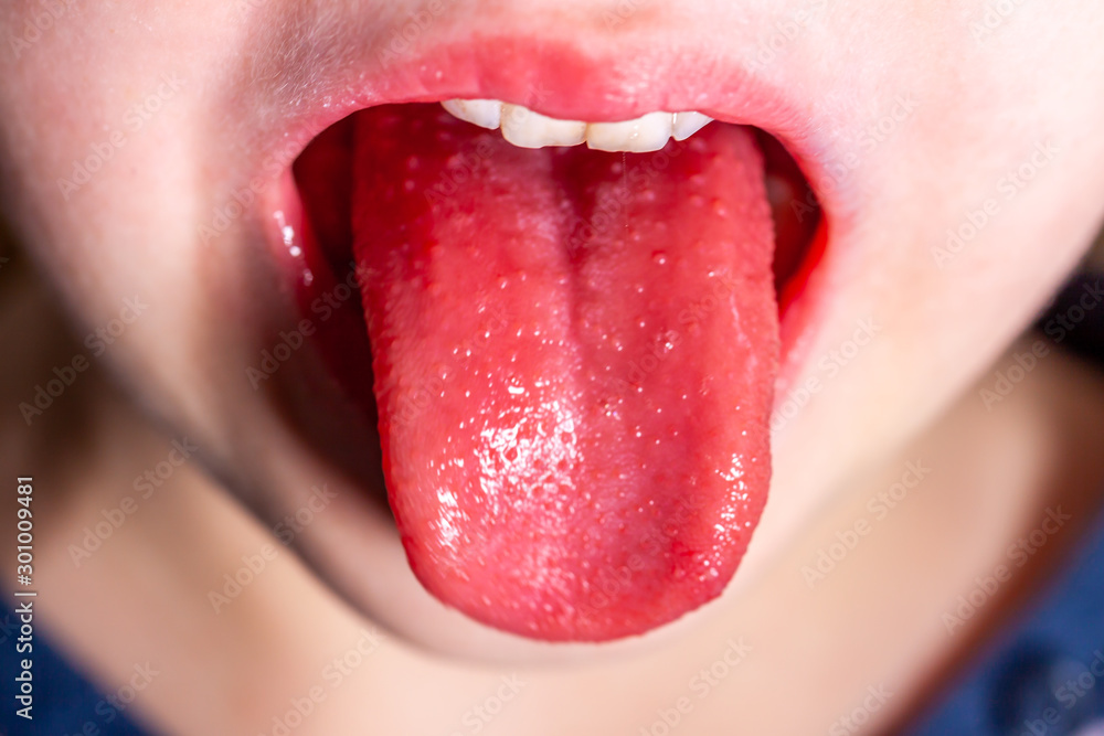 Tongue of a child with scarlet fever - strawberry tongue - obrazy, fototapety, plakaty 